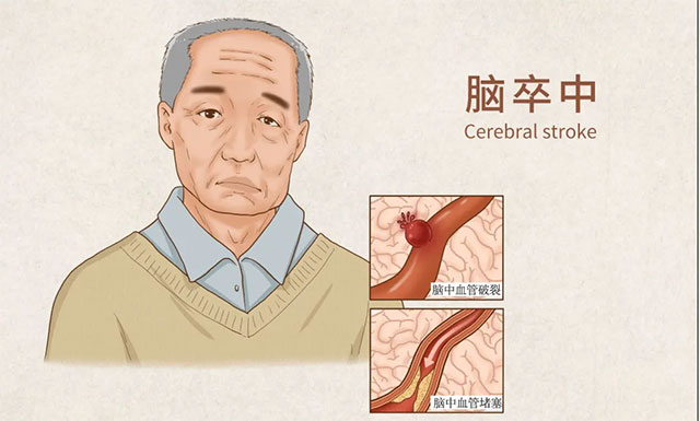 心梗患者和高风险人群使用须谨慎 阿奇霉素