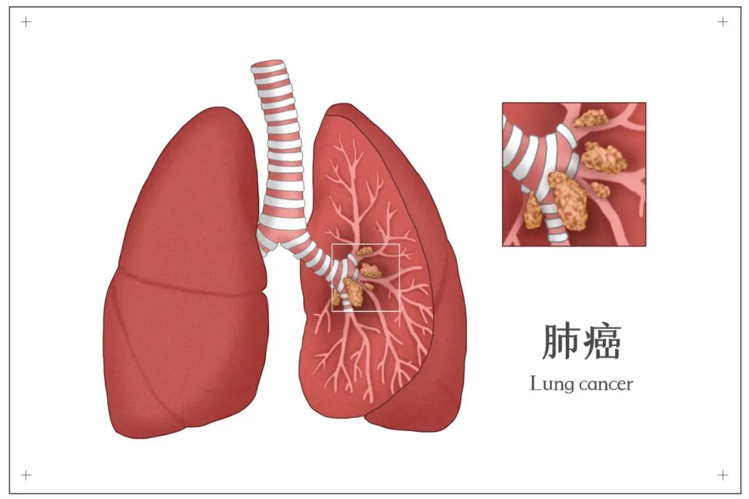 肺肿瘤患者肩膀疼痛 症状和缓解措施 原因