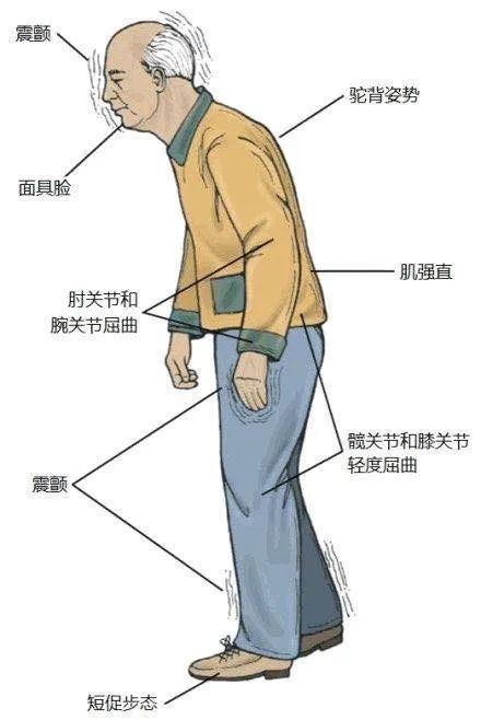 帕金森病安冬攻略 帕金森病患者如何在凛冬中从容前行