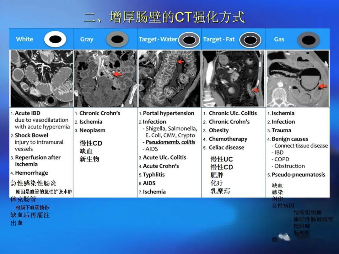 CT与肠镜的较量——刘波说影像 肠癌筛查之惑