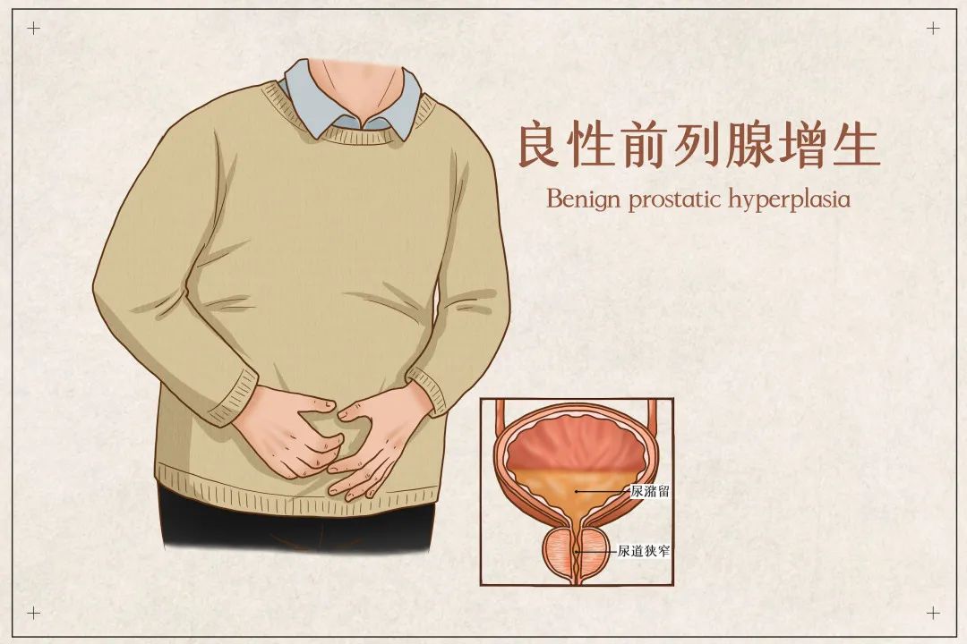 前列腺增大体检后的应对措施 医学小常识指南