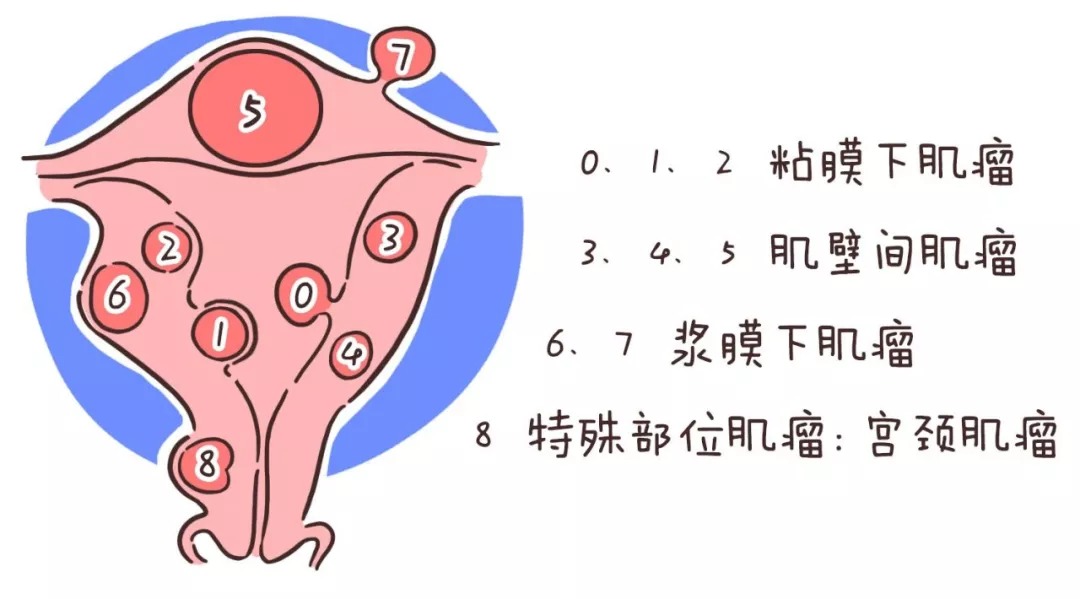 了解这种常见妇科