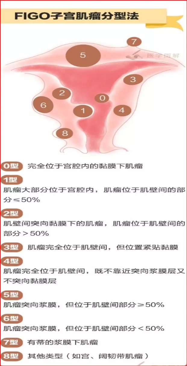 子宫肌瘤的复发风险 女星切除子宫肌瘤3个月后复发