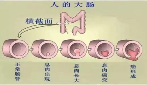 肠癌的可怕真相 29岁网红确诊肠癌8月去世