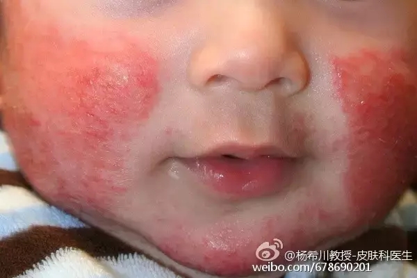 宝宝湿疹的自愈之谜 了解湿疹的自然病程