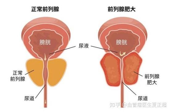 前列腺增大体检提示 正确处理和应对措施