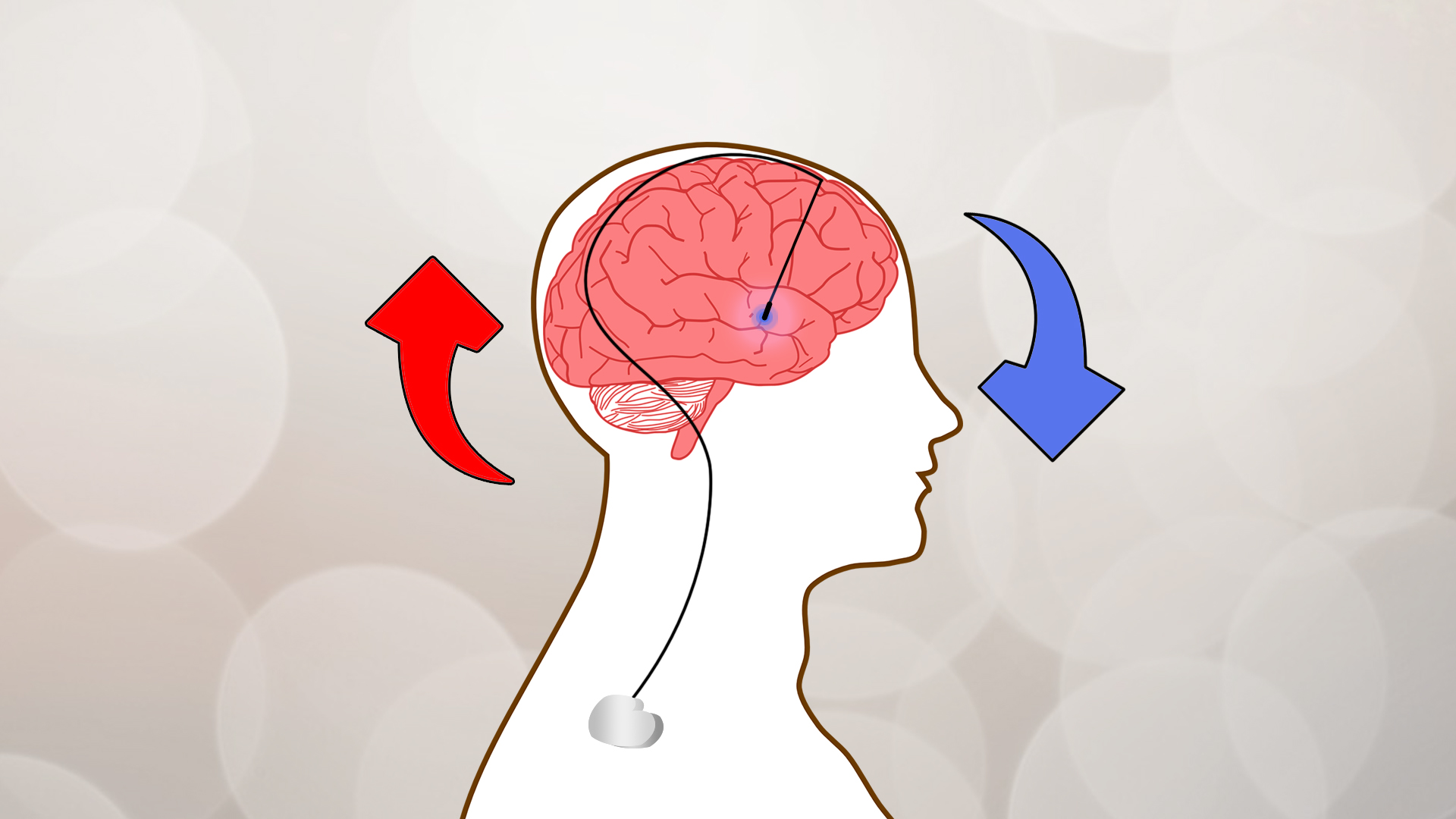 开启脑机接口新时代 全球首次语言运动双解码脑机接口临床试验在上海成功完成