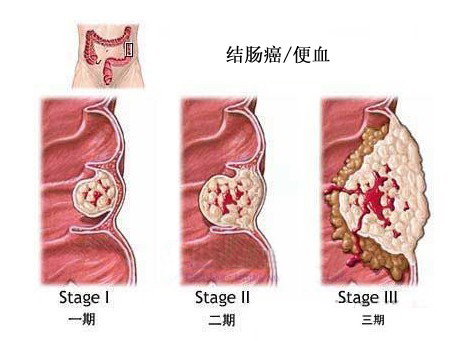 发病率