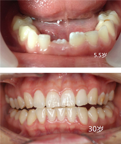 孩子新长出的门牙出现锯齿状 随着年龄增长会消失吗