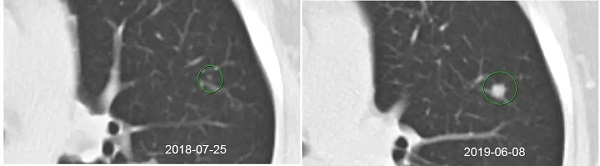 肺结节良恶之辨 及早筛查避免延误 尺寸与症状解读