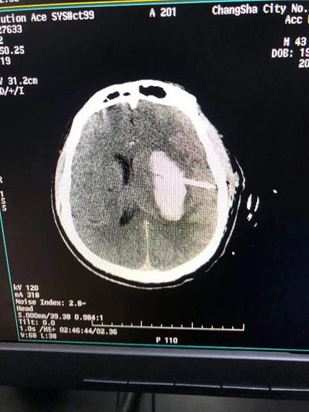 脑部发现大血栓 盖尔·加朵怀孕8个月紧急手术