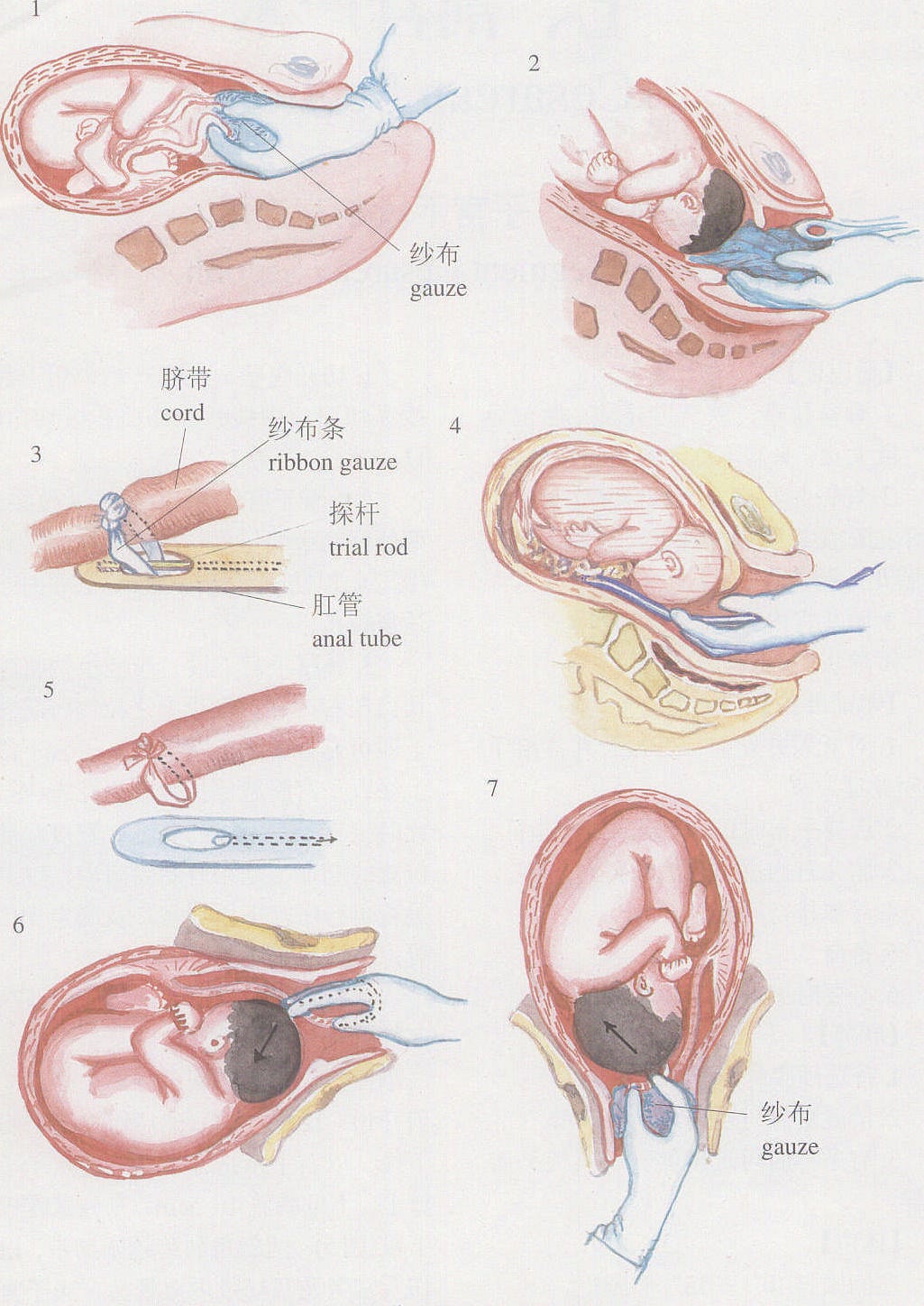 广东一脐带绕颈6圈